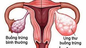 xét nghiệm Roma test là gì