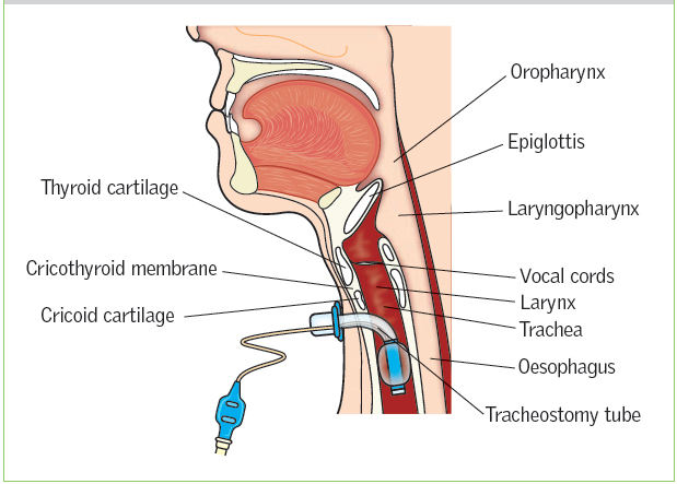 ống đặt nội khí quản